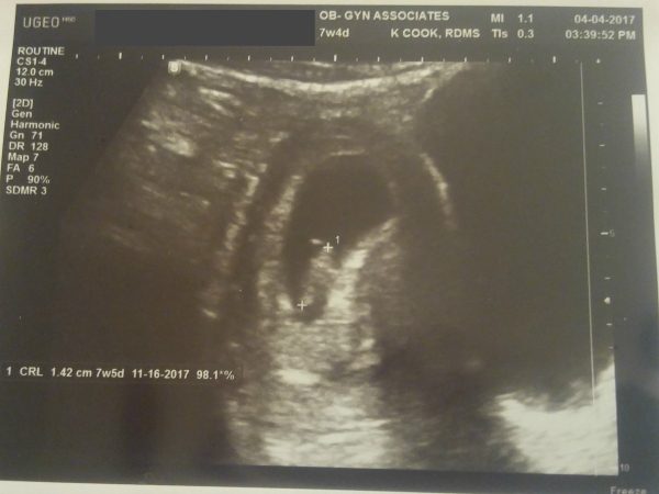 7.5 week sonogram